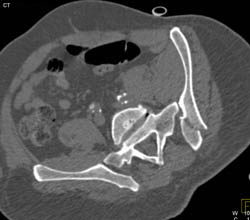 Iliac Wing and Pelvic Fractures Without Bladder Injury - CTisus CT Scan