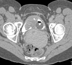 Bladder Cancer With Blood Clots in Bladder - CTisus CT Scan