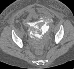 Perforated Bladder on CT Cystogram - CTisus CT Scan