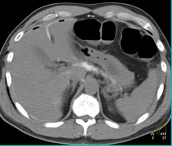 Intraperitoneal Rupture of Bladder With Contrast Around Bowel Loops - CTisus CT Scan