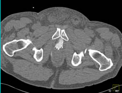 Extraperitoneal Rupture of Bladder on CT Cystogram - CTisus CT Scan