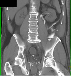 Intraperitoneal Contrast S/P Prostatectomy and Bladder Injury - CTisus CT Scan