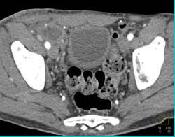 Inguinal Hernia With Bowel Extends Into the Scrotum With Collateral Vessels - CTisus CT Scan