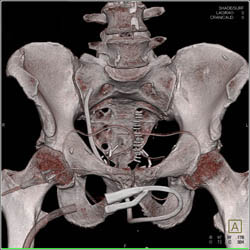 Drains in Pelvis in Patient S/P Prostatectomy With Leak From Bladder on CT Cystogram- See Full Sequence of Images - CTisus CT Scan