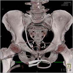 Drains in Pelvis in Patient S/P Prostatectomy With Leak From Bladder on CT Cystogram- See Full Sequence of Images - CTisus CT Scan