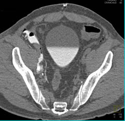 Drains in Pelvis in Patient S/P Prostatectomy With Leak From Bladder on CT Cystogram- See Full Sequence of Images - CTisus CT Scan