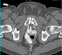 Drains in Pelvis in Patient S/P Prostatectomy With Leak From Bladder on CT Cystogram- See Full Sequence of Images - CTisus CT Scan