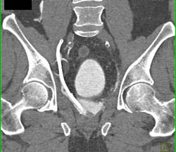 Drains in Pelvis in Patient S/P Prostatectomy With Leak From Bladder on CT Cystogram- See Full Sequence of Images - CTisus CT Scan