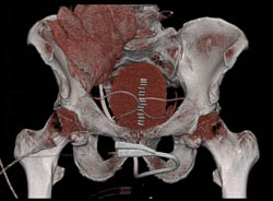 Drains in Pelvis in Patient S/P Prostatectomy With Leak From Bladder on CT Cystogram- See Full Sequence of Images - CTisus CT Scan