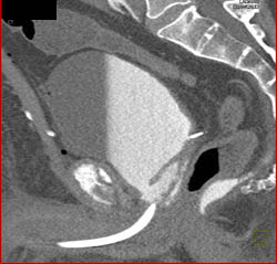 Drains in Pelvis in Patient S/P Prostatectomy With Leak From Bladder on CT Cystogram- See Full Sequence of Images - CTisus CT Scan