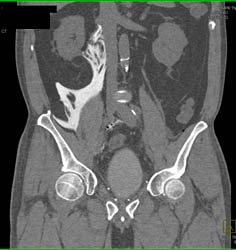 Drains in Pelvis in Patient S/P Prostatectomy With Leak From Bladder on CT Cystogram- See Full Sequence of Images - CTisus CT Scan