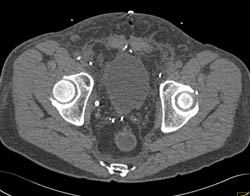 Drains in Pelvis in Patient S/P Prostatectomy With Leak From Bladder on CT Cystogram- See Full Sequence of Images - CTisus CT Scan