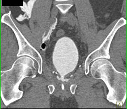 Drains in Pelvis in Patient S/P Prostatectomy With Leak From Bladder on CT Cystogram- See Full Sequence of Images - CTisus CT Scan