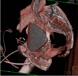 Drains in Pelvis in Patient S/P Prostatectomy With Leak From Bladder on CT Cystogram- See Full Sequence of Images - CTisus CT Scan