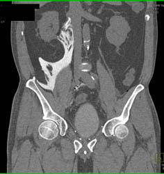 Drains in Pelvis in Patient S/P Prostatectomy With Leak From Bladder on CT Cystogram- See Full Sequence of Images - CTisus CT Scan