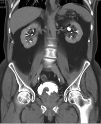 Deformed Bladder S/P Transurethral Resection of the Prostate (TURP) - CTisus CT Scan