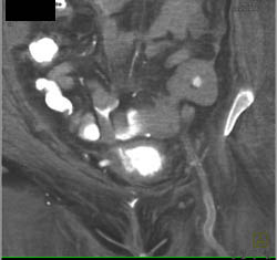 Fistulae From Bladder to Bowel - CTisus CT Scan