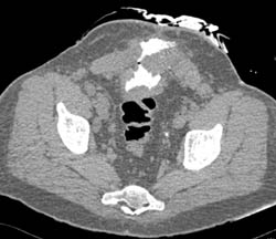 Fistulae Bladder to Abdominal Wall - CTisus CT Scan