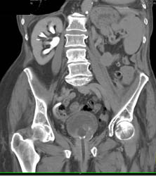 Bladder Cancer - CTisus CT Scan