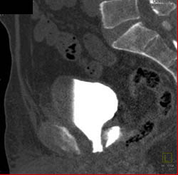 Leak From Bladder S/P Prostatectomy - CTisus CT Scan