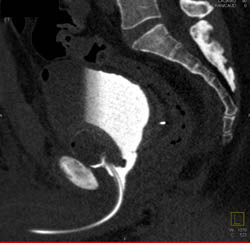 Leak From Urethra - CTisus CT Scan