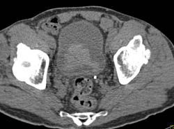 Bladder Cancer - CTisus CT Scan