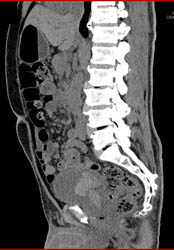 Bladder Cancer - CTisus CT Scan