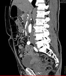 Bladder Cancer - CTisus CT Scan