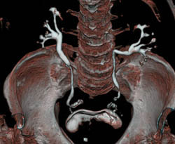 Prostate Cancer With CT Urogram - CTisus CT Scan