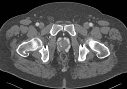 Pelvic Arteriovenous Malformation (AVM) With Huge Collaterals - CTisus CT Scan