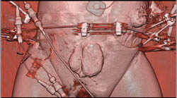 Prune Belly - CTisus CT Scan