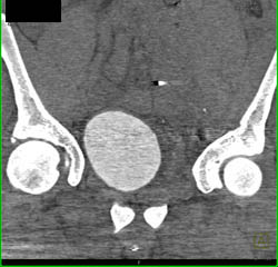 Bladder Displaced By Hematoma S/P GSW - CTisus CT Scan