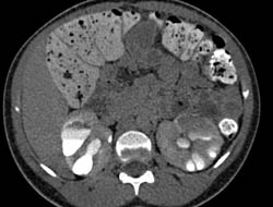 Ct Cystogram With Prune Belly and Dilated Calyces - CTisus CT Scan