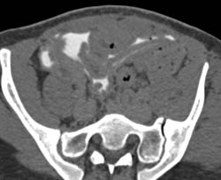 Bladder Perforation With Intra-peritoneal Perforation - CTisus CT Scan