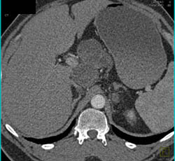 Testicular Cancer With Adenopathy - CTisus CT Scan