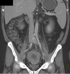 Necrotic Cancer of the Uterus With Liver Metastases - CTisus CT Scan