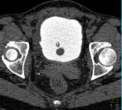 Subtle Bladder Leak- 9 O Clock - CTisus CT Scan