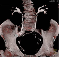 Neobladder on CT Urogram - CTisus CT Scan