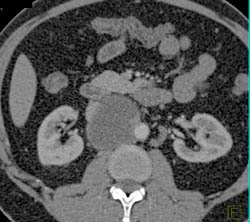 Testicular Cancer With Cystic Nodes - CTisus CT Scan