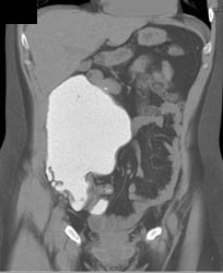 Neobladder With CT Cystogram Without Leak - CTisus CT Scan