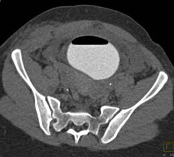 Ct Cystogram With Pelvic Hematoma S/P Trauma - CTisus CT Scan