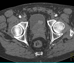 Bladder Cancer With Tumor in Bladder - CTisus CT Scan