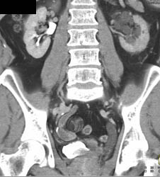 Bladder Cancer - CTisus CT Scan