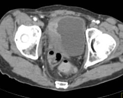 Bladder Cancer With Perivesical Spread - CTisus CT Scan