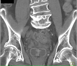 Ct Cystogram With Diverticuli - CTisus CT Scan