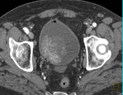 Bladder Cancer- Enhancing Mass - CTisus CT Scan