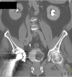 Ulcerating Bladder Cancer - CTisus CT Scan