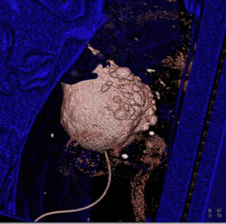 Bladder Diverticuli in 3D on CT Urogram - CTisus CT Scan