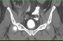 Intraperitoneal Rupture of the Bladder Following Robotic Prostatectomy - CTisus CT Scan