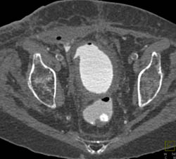 Ct Cystogram With Renal and Pancreatic Transplants - CTisus CT Scan